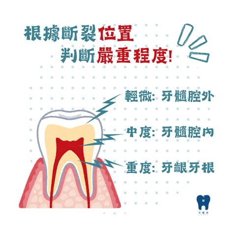 牙齒掉了|牙齒意外脫落之照護